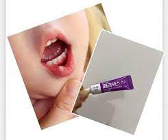 PERIDEX GEL – FAST RELIEF FOR MOUTH ULCERS!  (10g)