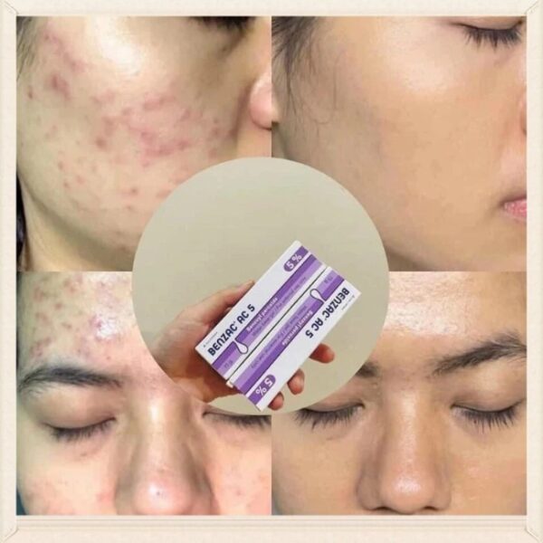 BENZAC AC 5% (Benzoyl Peroxide Water-Based Gel)
