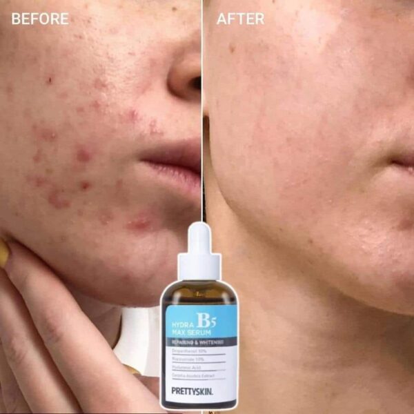 350276960_264201426024293_6736253673073045543_n PRETTYSKIN Hydra B5 Max Serum ( 50ml )
